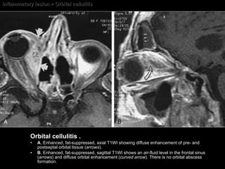 Inflammatory lesion > Orbital cellulitis Orbital cellulitis . A , Enhanced, fat-suppressed, axial T1WI showing diffuse enhancement of pre- and postseptal orbital tissue ( arrows ).  B , Enhanced, fat-suppressed, sagittal T1WI shows an air-fluid level in the frontal sinus ( arrows ) and diffuse orbital enhancement ( curved arrow ). There is no orbital abscess formation. 