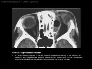 Inflammatory lesion > Orbital cellulitis Orbital subperiosteal abscess.   CT scan shows proptosis of the left eye with mucosal thickening of the ethmoid air cells (E), with subperiosteal abscess (hollow arrow). Note the air bubble (arrowhead ) within the abscess and the swollen left medial rectus muscle (arrow). 