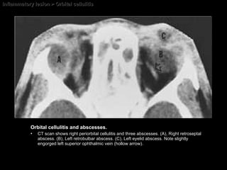 Inflammatory lesion > Orbital cellulitis Orbital cellulitis and abscesses.  CT scan shows right periorbital cellulitis and three abscesses. (A), Right retroseptal abscess. (B), Left retrobulbar abscess. (C), Left eyelid abscess. Note slightly engorged left superior ophthalmic vein (hollow arrow). 