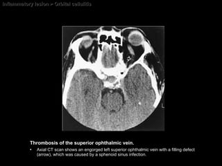 Inflammatory lesion > Orbital cellulitis Thrombosis of the superior ophthalmic vein.   Axial CT scan shows an engorged left superior ophthalmic vein with a filling defect (arrow), which was caused by a sphenoid sinus infection. 