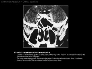 Inflammatory lesion > Orbital cellulitis Bilateral cavernous sinus thrombosis.  Coronal CT section through the cavernous sinus following bolus injection reveals opacification of the internal carotid arteries bilaterally.  The cavernous sinus reveals decreased attenuation in keeping with cavernous sinus thrombosis.  Note enhancement of the dura bordering the left cavernous sinus. 