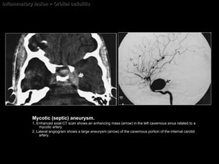 Inflammatory lesion > Orbital cellulitis Mycotic (septic) aneurysm.  1, Enhanced axial CT scan shows an enhancing mass (arrow) in the left cavernous sinus related to a mycotic artery.  2, Lateral angiogram shows a large aneurysm (arrow) of the cavernous portion of the internal carotid artery. 