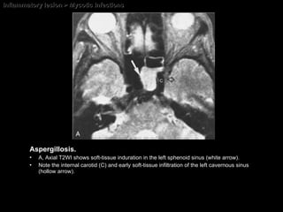 Inflammatory lesion > Mycotic Infections Aspergillosis. A, Axial T2WI shows soft-tissue induration in the left sphenoid sinus (white arrow).  Note the internal carotid (C) and early soft-tissue infiltration of the left cavernous sinus (hollow arrow). 