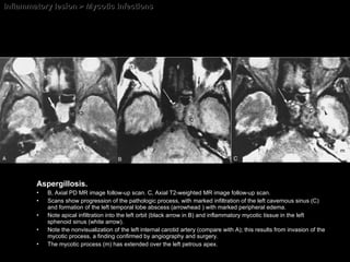 Inflammatory lesion > Mycotic Infections Aspergillosis. B, Axial PD MR image follow-up scan. C, Axial T2-weighted MR image follow-up scan.  Scans show progression of the pathologic process, with marked infiltration of the left cavernous sinus (C) and formation of the left temporal lobe abscess (arrowhead ) with marked peripheral edema.  Note apical infiltration into the left orbit (black arrow in B) and inflammatory mycotic tissue in the left sphenoid sinus (white arrow).  Note the nonvisualization of the left internal carotid artery (compare with A); this results from invasion of the mycotic process, a finding confirmed by angiography and surgery.  The mycotic process (m) has extended over the left petrous apex. 
