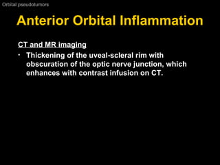 Anterior Orbital Inflammation Orbital pseudotumors  CT and MR imaging   Thickening of the uveal-scleral rim with obscuration of the optic nerve junction, which enhances with contrast infusion on CT. 