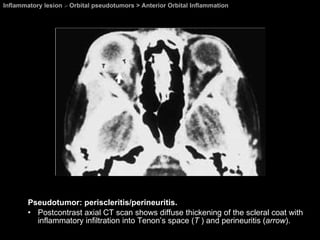 Inflammatory lesion  >  Orbital pseudotumors > Anterior Orbital Inflammation Pseudotumor: periscleritis/perineuritis. Postcontrast axial CT scan shows diffuse thickening of the scleral coat with inflammatory infiltration into Tenon’s space ( T  ) and perineuritis ( arrow ). 