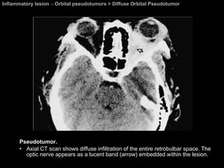 Inflammatory lesion  >  Orbital pseudotumors > Diffuse Orbital Pseudotumor Pseudotumor. Axial CT scan shows diffuse infiltration of the entire retrobulbar space. The optic nerve appears as a lucent band (arrow) embedded within the lesion. 