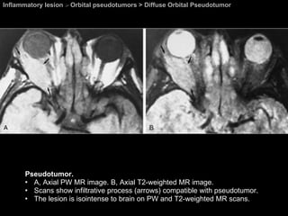 Inflammatory lesion  >  Orbital pseudotumors > Diffuse Orbital Pseudotumor Pseudotumor. A, Axial PW MR image. B, Axial T2-weighted MR image.  Scans show infiltrative process (arrows) compatible with pseudotumor.  The lesion is isointense to brain on PW and T2-weighted MR scans.  