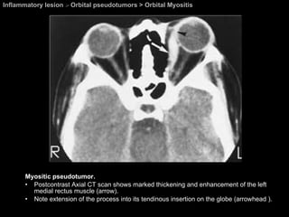 Inflammatory lesion  >  Orbital pseudotumors > Orbital Myositis Myositic pseudotumor.  Postcontrast Axial CT scan shows marked thickening and enhancement of the left medial rectus muscle (arrow).  Note extension of the process into its tendinous insertion on the globe (arrowhead ). 