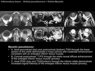 Inflammatory lesion  >  Orbital pseudotumors > Orbital Myositis Myositic pseudotumor.  A, Axial precontrast (top) and postcontrast (bottom) TIWI through the lower portion of the orbits demonstrate a mass (arrow) with moderate enhancement consistent with an enlarged inferior rectus muscle.  B, Coronal postcontrast, T1FS through the orbits reveal diffuse enhancement of the enlarged inferior rectus muscle (arrows). C, Axial PDW (top) and T2WI(bottom) through the inferior orbits demonstrate increased signal intensity of the enlarged inferior rectus muscle (arrows).  