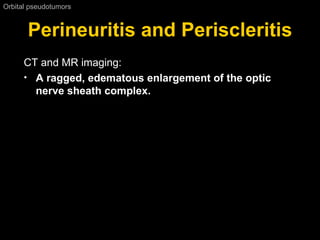 Perineuritis and Periscleritis Orbital pseudotumors  CT and MR imaging: A ragged, edematous enlargement of the optic nerve sheath complex. 