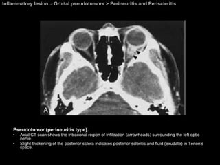 Inflammatory lesion  >  Orbital pseudotumors > Perineuritis and Periscleritis Pseudotumor (perineuritis type).  Axial CT scan shows the intraconal region of infiltration (arrowheads) surrounding the left optic nerve.  Slight thickening of the posterior sclera indicates posterior scleritis and fluid (exudate) in Tenon’s space. 