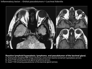 Inflammatory lesion  >  Orbital pseudotumors > Lacrimal Adenitis Reactive lymphoid hyperplasia, lymphoma, and pseudotumor of the lacrimal gland.  A, Axial proton-weighted MR image showing a presumed reactive lymphoid hyperplasia (arrow).  B, Axial T1WI showing lacrimal gland lymphoma (arrow).  C, Axial T1WI showing pseudotumor of the lacrimal gland (arrow). 