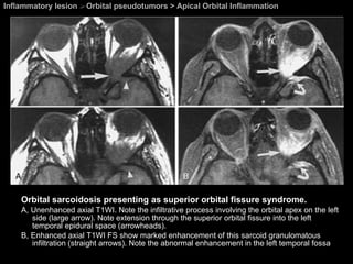 Inflammatory lesion  >  Orbital pseudotumors > Apical Orbital Inflammation Orbital sarcoidosis presenting as superior orbital fissure syndrome.  A, Unenhanced axial T1WI. Note the infiltrative process involving the orbital apex on the left side (large arrow). Note extension through the superior orbital fissure into the left temporal epidural space (arrowheads). B, Enhanced axial T1WI FS show marked enhancement of this sarcoid granulomatous infiltration (straight arrows). Note the abnormal enhancement in the left temporal fossa 