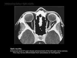 Inflammatory lesion > Optic neuritis Optic neuritis.  Enhanced axial CT scan shows enhancement of the left optic nerve (arrow). This may not be differentiated from sarcoidosis or meningioma. 