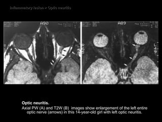 Inflammatory lesion > Optic neuritis Optic neuritis.  Axial PW (A) and T2W (B)  images show enlargement of the left entire optic nerve (arrows) in this 14-year-old girl with left optic neuritis. 