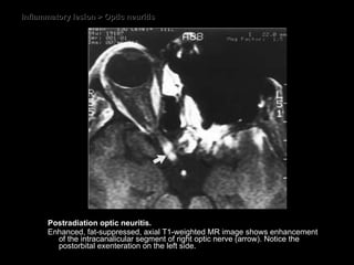Inflammatory lesion > Optic neuritis Postradiation optic neuritis.  Enhanced, fat-suppressed, axial T1-weighted MR image shows enhancement of the intracanalicular segment of right optic nerve (arrow). Notice the postorbital exenteration on the left side. 