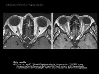 Inflammatory lesion > Optic neuritis Optic neuritis.  (A) Enhanced axial T1WI and (B) enhanced axial fat-suppression T1W MR scans showing marked enhancement of intraorbital (black arrows) and intracanalicular segments (white arrows) of optic nerves. Biopsy revealed a demyelinating process. 