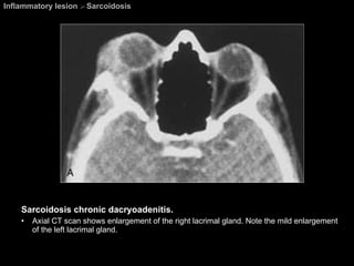 Inflammatory lesion  >  Sarcoidosis Sarcoidosis chronic dacryoadenitis.  Axial CT scan shows enlargement of the right lacrimal gland. Note the mild enlargement of the left lacrimal gland. 
