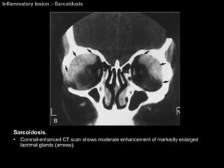 Inflammatory lesion  >  Sarcoidosis Sarcoidosis.  Coronal-enhanced CT scan shows moderate enhancement of markedly enlarged lacrimal glands (arrows). 