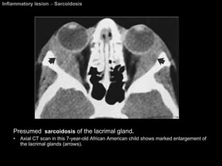 Inflammatory lesion  >  Sarcoidosis Presumed   sarcoidosis  of the lacrimal gland .  Axial CT scan in this 7-year-old African American child shows marked enlargement of the lacrimal glands (arrows). 