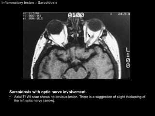 Inflammatory lesion  >  Sarcoidosis Sarcoidosis with optic nerve involvement. Axial T1WI scan shows no obvious lesion. There is a suggestion of slight thickening of the left optic nerve (arrow). 