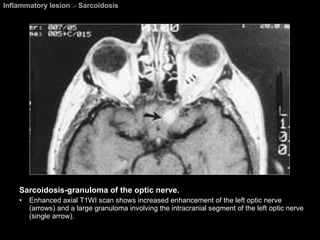 Inflammatory lesion  >  Sarcoidosis Sarcoidosis-granuloma of the optic nerve. Enhanced axial T1WI scan shows increased enhancement of the left optic nerve (arrows) and a large granuloma involving the intracranial segment of the left optic nerve (single arrow). 