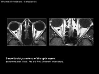Inflammatory lesion  >  Sarcoidosis Sarcoidosis-granuloma of the optic nerve. Enhanced axail T1WI : Pre and Post treatment with steroid. 