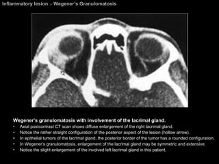 Inflammatory lesion  >  Wegener’s Granulomatosis Wegener’s granulomatosis with involvement of the lacrimal gland.  Axial postcontrast CT scan shows diffuse enlargement of the right lacrimal gland.  Notice the rather straight configuration of the posterior aspect of the lesion (hollow arrow). In epithelial tumors of the lacrimal gland, the posterior border of the tumor has a rounded configuration. In Wegener’s granulomatosis, enlargement of the lacrimal gland may be symmetric and extensive.  Notice the slight enlargement of the involved left lacrimal gland in this patient.  