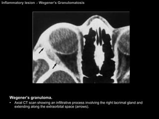 Inflammatory lesion  >  Wegener’s Granulomatosis Wegener’s granuloma.  Axial CT scan showing an infiltrative process involving the right lacrimal gland and extending along the extraorbital space (arrows). 
