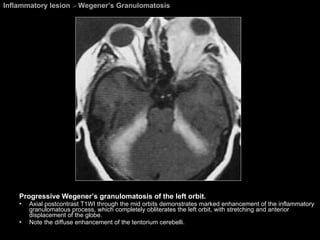 Inflammatory lesion  >  Wegener’s Granulomatosis Progressive Wegener’s granulomatosis of the left orbit. Axial postcontrast T1WI through the mid orbits demonstrates marked enhancement of the inflammatory granulomatous process, which completely obliterates the left orbit, with stretching and anterior displacement of the globe.  Note the diffuse enhancement of the tentorium cerebelli.  