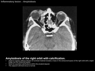 Inflammatory lesion  >  Amyloidosis Amyloidosis of the right orbit with calcification. Axial CT section without infusion of contrast material reveals a mass in the extraconal space of the right orbit with a slight bulge into the intraconal space.  Note the speckled calcifications within the amyloid deposit.  The adjacent ethmoid sinus is normal. 