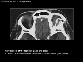 Inflammatory lesion  >  Amyloidosis Amyloidosis of the lacrimal gland and orbit.  Axial CT scan shows marked calcification of the left lacrimal gland (arrow). 