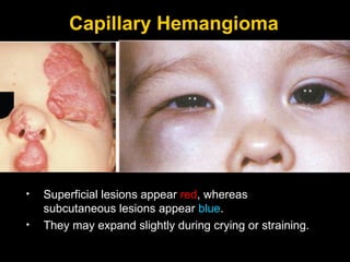 Capillary Hemangioma (Benign Hemangioendothelioma)   Superficial lesions appear  red , whereas subcutaneous lesions appear  blue .  They may expand slightly during crying or straining.  
