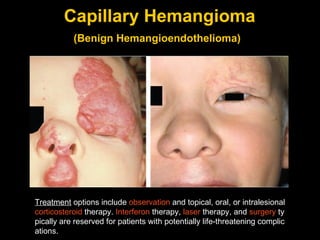 Capillary Hemangioma (Benign Hemangioendothelioma)   Treatment  options include  observation  and topical, oral, or intralesional  corticosteroid  therapy.  Interferon  therapy,  laser  therapy, and  surgery  typically are reserved for patients with potentially life-threatening complications . 