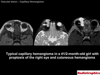Vascular lesion  >  Capillary Hemangioma Typical capillary hemangioma in a 41/2-month-old girl with proptosis of the right eye and cutaneous hemangioma 