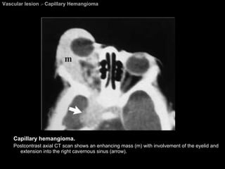 Vascular lesion  >  Capillary Hemangioma Capillary hemangioma.  Postcontrast axial CT scan shows an enhancing mass (m) with involvement of the eyelid and extension into the right cavernous sinus (arrow). 