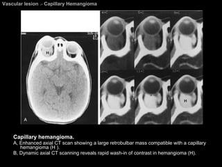 Vascular lesion  >  Capillary Hemangioma Capillary hemangioma.  A, Enhanced axial CT scan showing a large retrobulbar mass compatible with a capillary hemangioma (H ).  B, Dynamic axial CT scanning reveals rapid wash-in of contrast in hemangioma (H). 