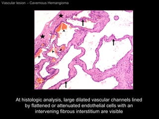 At histologic analysis, large dilated vascular channels lined by flattened or attenuated endothelial cells with an intervening fibrous interstitium are visible Vascular lesion  >  Cavernous Hemangioma 