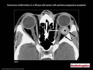 Copyright ©Radiological Society of North America, 2008 CECT Cavernous malformation in a 39-year-old woman with painless progressive proptosis 
