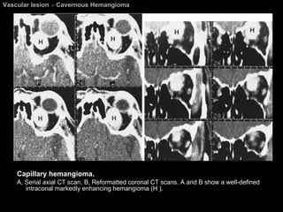 Vascular lesion  >  Cavernous Hemangioma Capillary hemangioma.  A, Serial axial CT scan. B, Reformatted coronal CT scans. A and B show a well-defined intraconal markedly enhancing hemangioma (H ). 