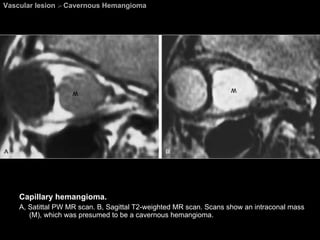 Vascular lesion  >  Cavernous Hemangioma Capillary hemangioma.  A, Satittal PW MR scan. B, Sagittal T2-weighted MR scan. Scans show an intraconal mass (M), which was presumed to be a cavernous hemangioma. 