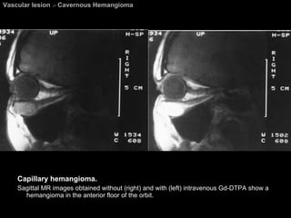 Vascular lesion  >  Cavernous Hemangioma Capillary hemangioma.  Sagittal MR images obtained without (right) and with (left) intravenous Gd-DTPA show a hemangioma in the anterior floor of the orbit. 