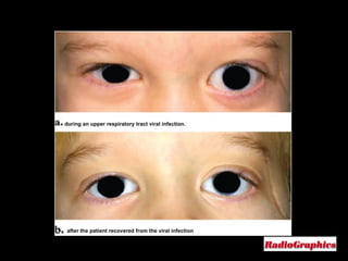 Copyright ©Radiological Society of North America, 2008 Venous lymphatic malformation in a 5-year-old girl during an upper respiratory tract viral infection. after the patient recovered from the viral infection 