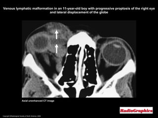 Copyright ©Radiological Society of North America, 2008 Axial unenhanced CT image Venous lymphatic malformation in an 11-year-old boy with progressive proptosis of the right eye and lateral displacement of the globe 