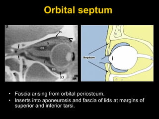 Orbital septum  Fascia arising from orbital periosteum. Inserts into aponeurosis and fascia of lids at margins of superior and inferior tarsi. 