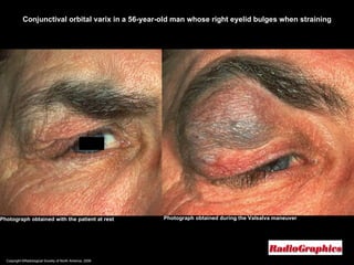 Copyright ©Radiological Society of North America, 2008 Photograph obtained with the patient at rest Conjunctival orbital varix in a 56-year-old man whose right eyelid bulges when straining Photograph obtained during the Valsalva maneuver 