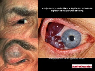 Copyright ©Radiological Society of North America, 2008 Conjunctival orbital varix in a 56-year-old man whose right eyelid bulges when straining Photograph obtained with the upper eyelid elevated 