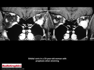 Copyright ©Radiological Society of North America, 2008 Orbital varix in a 33-year-old woman with proptosis when straining prone supine CE T1-weighted fat-suppressed images 