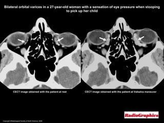 Copyright ©Radiological Society of North America, 2008 CECT image obtained with the patient at rest Bilateral orbital varices in a 27-year-old woman with a sensation of eye pressure when stooping to pick up her child CECT image obtained with the patient at Valsalva maneuver 